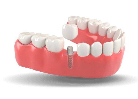 dental implant model