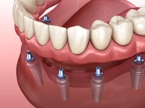 an implant supported dentures model showing how implant supported dentures use dental implants to secure a denture in place.