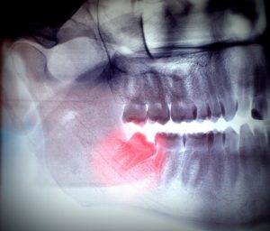 wisdom teeth pittsburgh pa