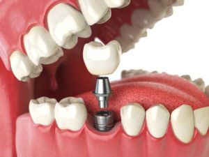 graphic of a dental implant being placed