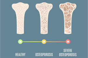 Osteoporosis Graphic