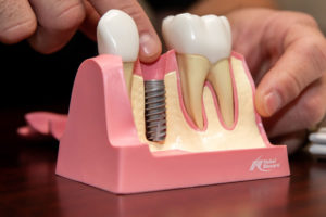 a model of a placed dental implant