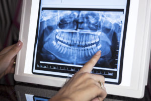 Dental XRay Diagram