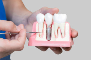 Dental Assistant Showing Off A Dental Implant In A Jawbone Cutaway Model in Monroeville, PA