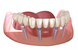 image of an all-on-4 dental implant model