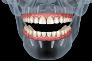 an all-on-4 full mouth dental implant digital visualization