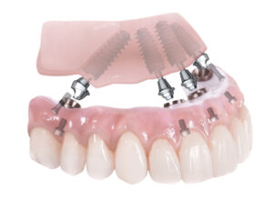 An image of a All-On-4 dental implant model.