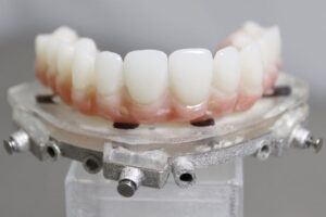 a chrome guided implant lower arch model.