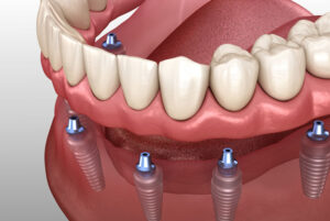 a digital implant of a lower arch with an implant supported denture being attached.