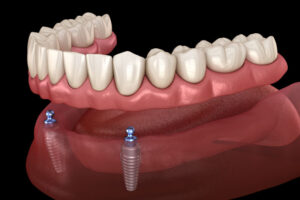 a digital implant of a lower arch with an implant supported denture being attached by multiole dental implants.