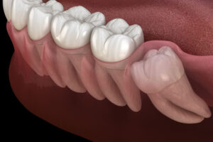 digital model of an impacted wisdom tooth in a jawline.