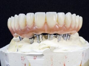implant supported denture model.
