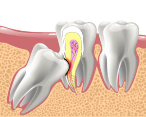 2d image showing how harmful wisdom teeth can be if not removed