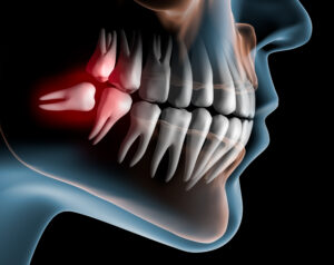 xray model of a problematic wisdom tooth
