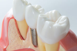 3d model of a dental implant