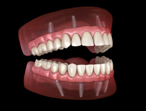 a 3D image of dental implants in Monroeville, PA.