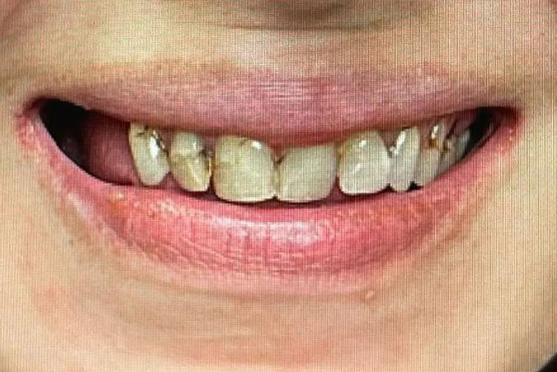 BEFORE