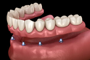 an implant supported dentures model showing how the dental implant posts and denture can be predictably placed following additional restorative procedures.