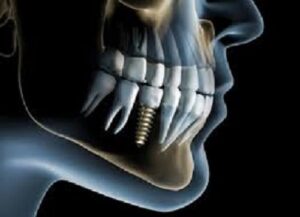 an image of a dental implant.