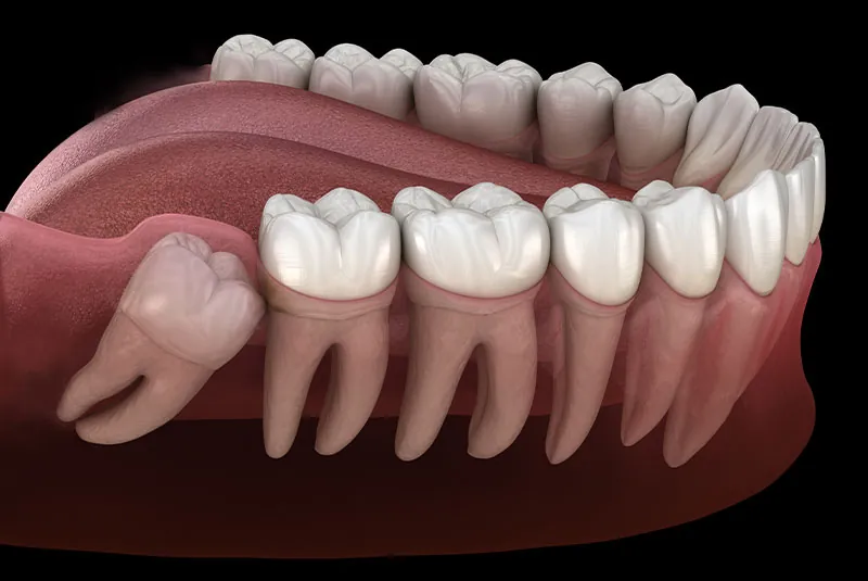 wisdom tooth