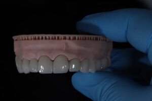 a full arch of teeth placed onto the mouth