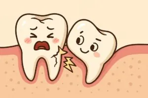 Image of a cartoon wisdom tooth growing in sideways, pushing against the roots of the adjacent molar, causing it to appear damaged and in pain. No text on image.