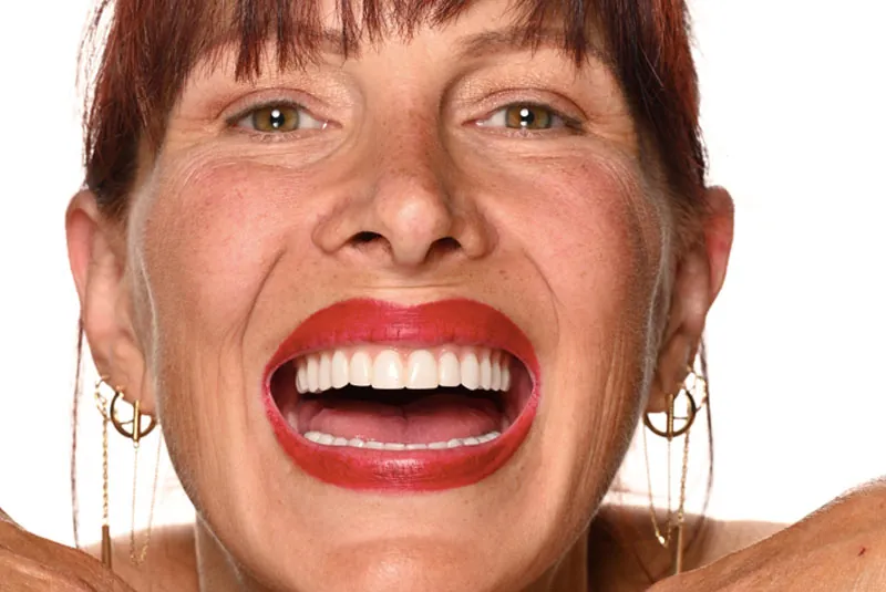 Garufi - Upper and Lower Arch Dental Implants