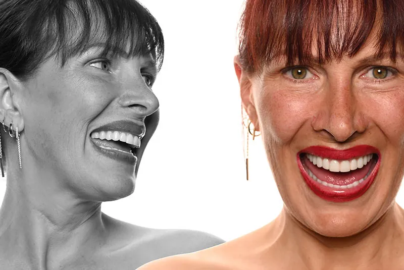 Garufi - Upper and Lower Arch Dental Implants