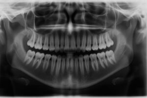 An x-ray image of an adult mouth, clearly showing 28 teeth present and empty spaces where wisdom teeth would typically be located. No text on the image.