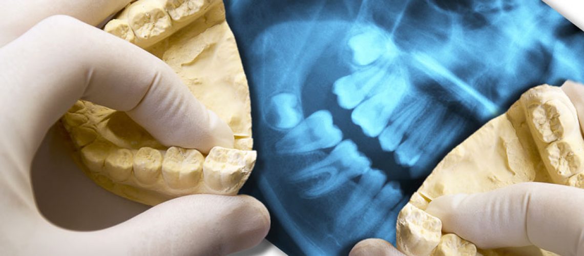 Dentist holding two jaw models at the wisdom tooth position with a Xray in the background
