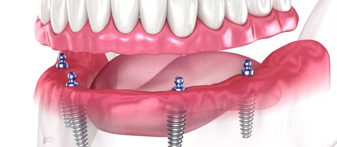 Dental prosthesis based on 4 implants. Dental 3D illustration