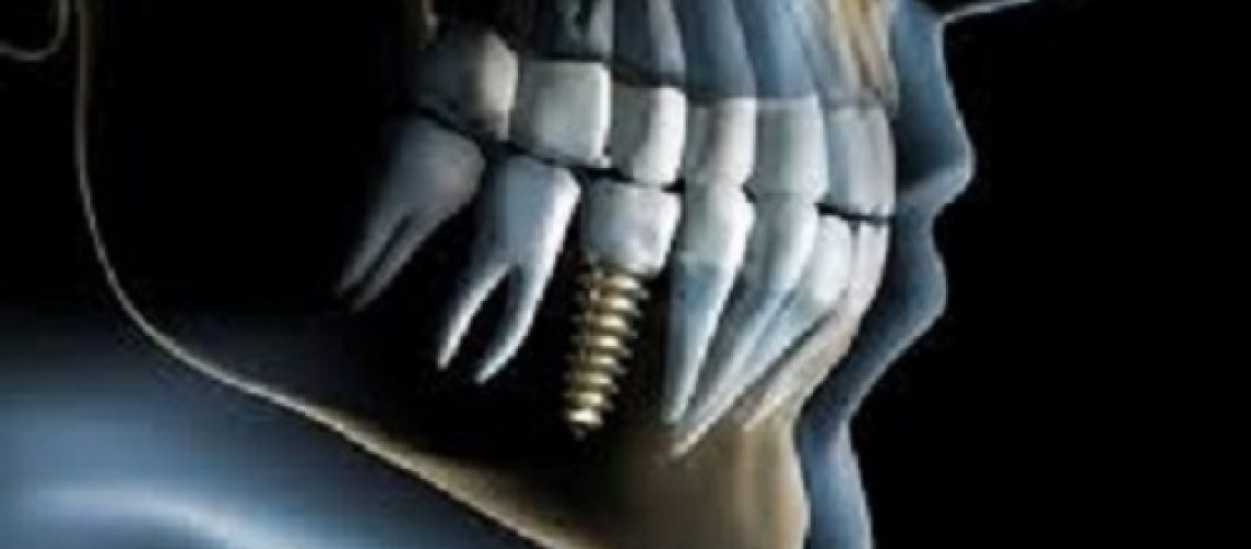 an image of a dental implant.