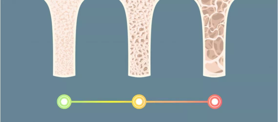 Osteoporosis Graphic