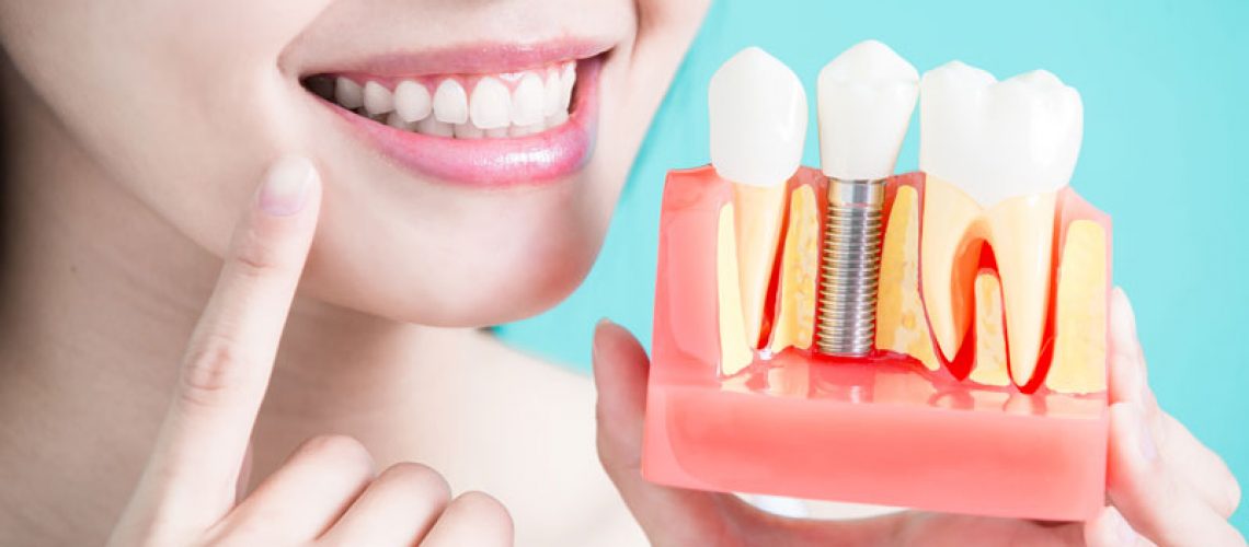 Patient Holding Dental Implant Model