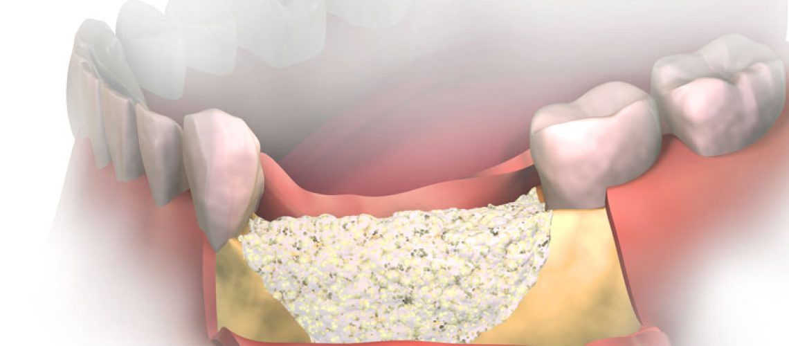 a bone grafting procedure digital model.
