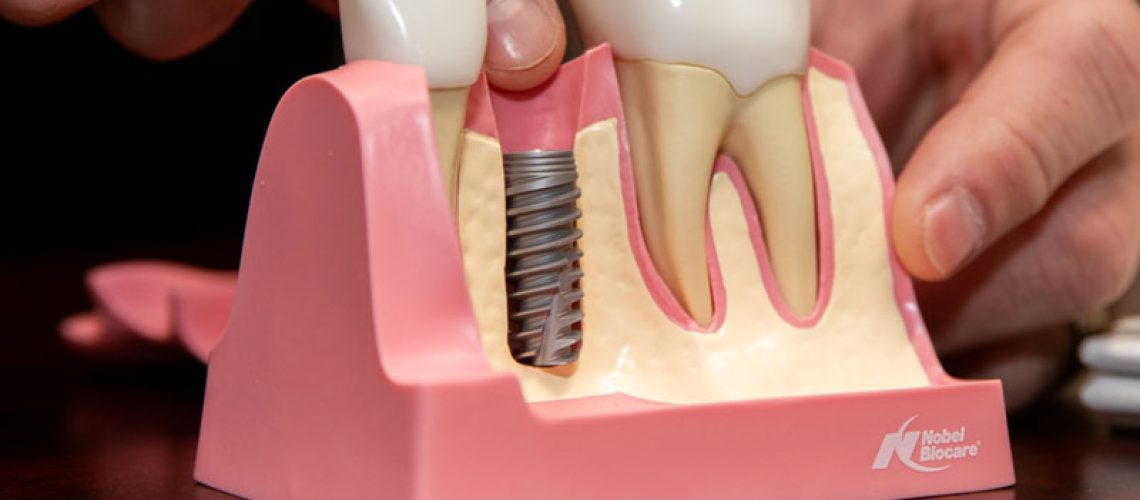 a model of a placed dental implant