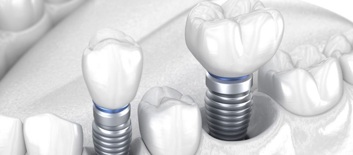 Dental Implant Model