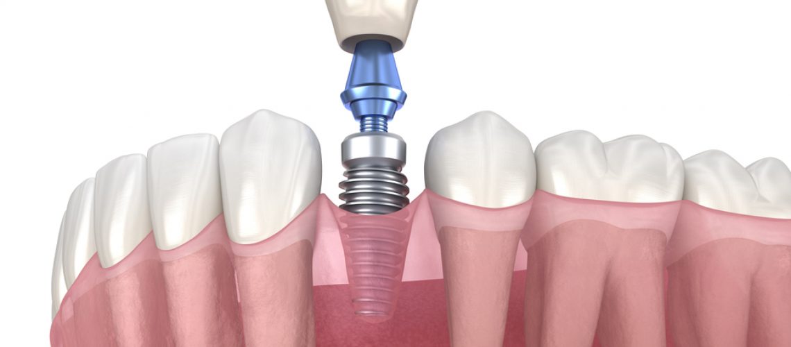 dentalimplantbeingplaced
