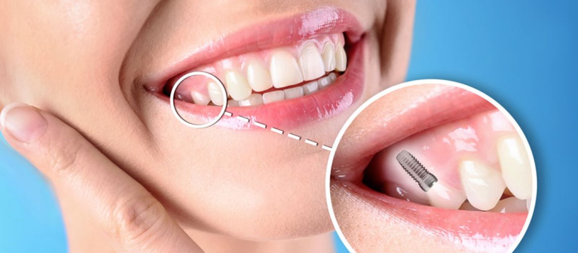 Female smiling with a diagram showing where her dental implant is at; blue background.
