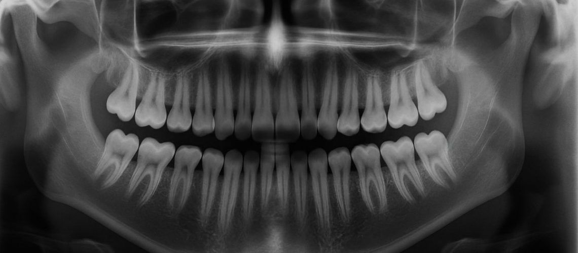 An x-ray image of an adult mouth, clearly showing 28 teeth present and empty spaces where wisdom teeth would typically be located. No text on the image.