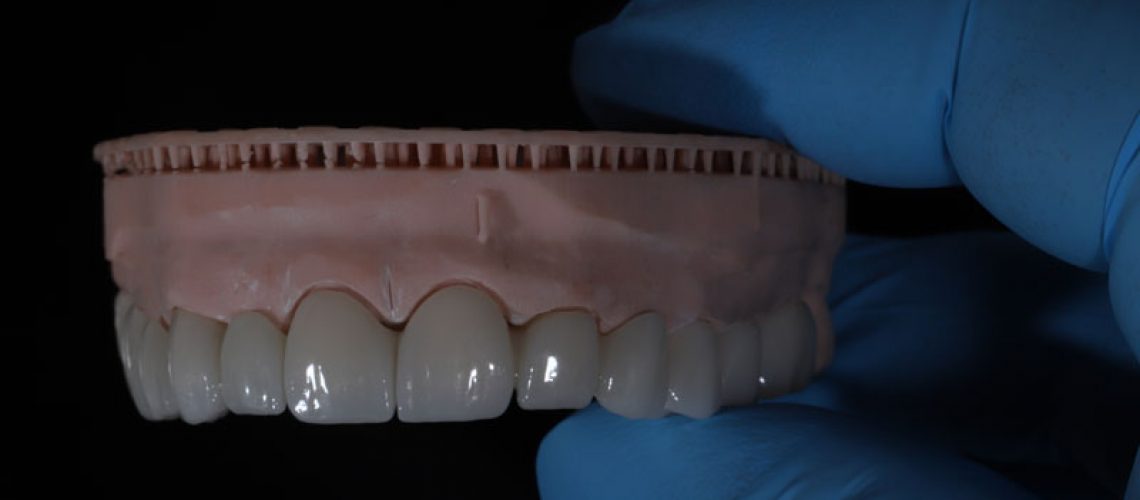 a full arch of teeth placed onto the mouth