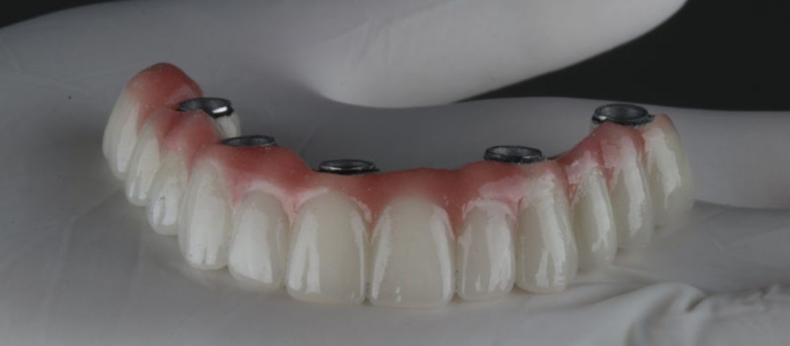 a full arch of dental implants with holes for placement going across it