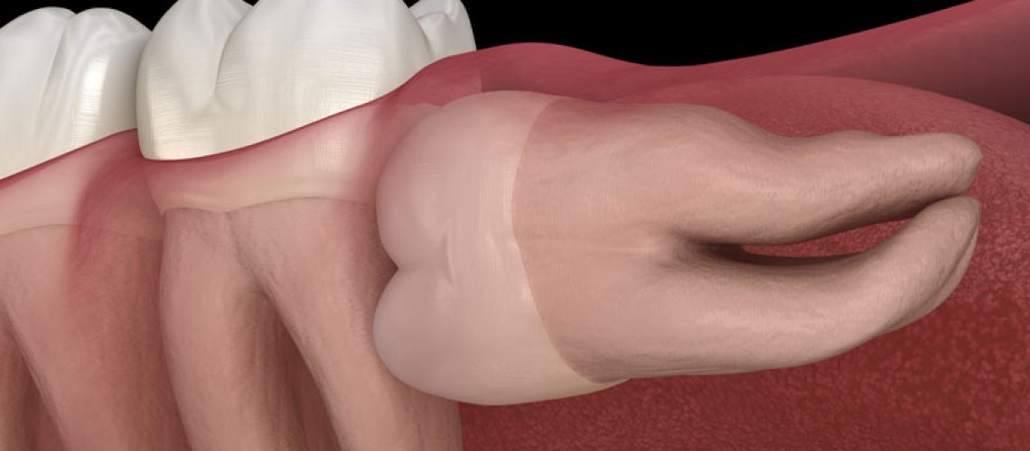 An image of a wisdom tooth that needs removed.