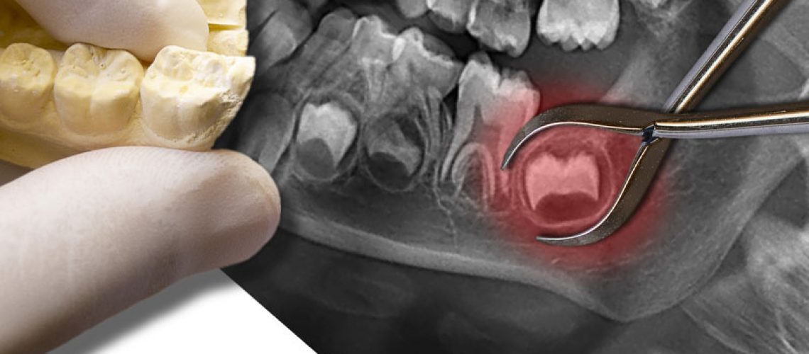 Impacted Wisdom Tooth XRay Graphic