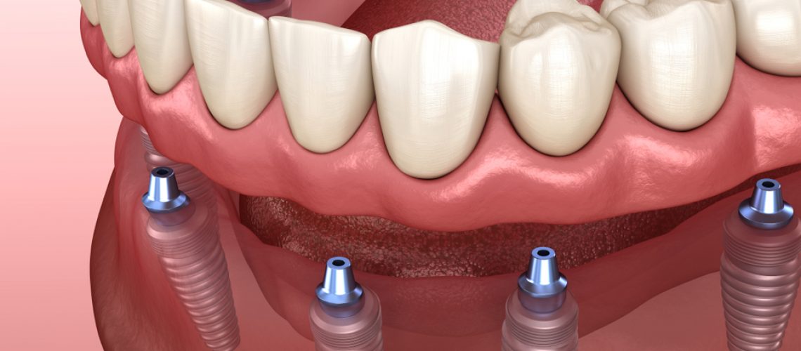 implant-dentures