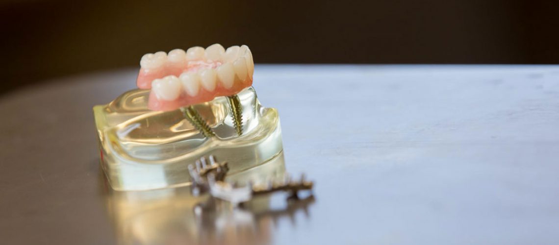 Model of all-on-4 dental implants