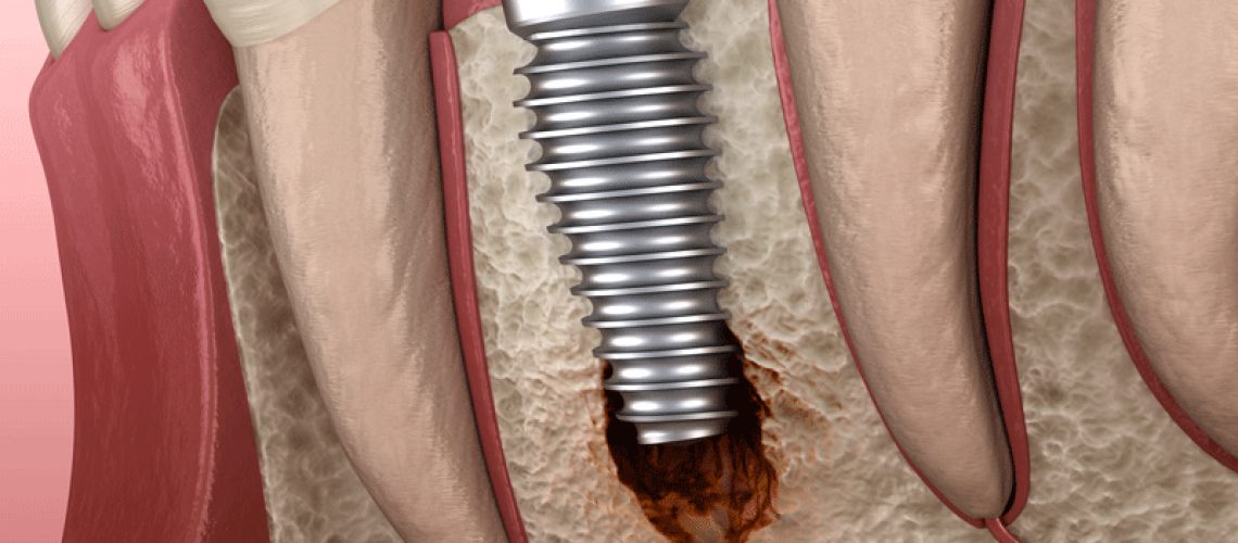 a single dental implant being affected by peri-implantiits